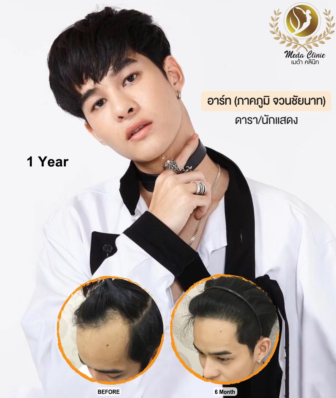 ปลูกผม เชียงใหม่