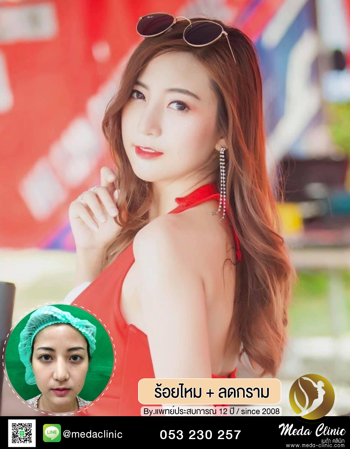 ร้อยไหม + ลดกราม