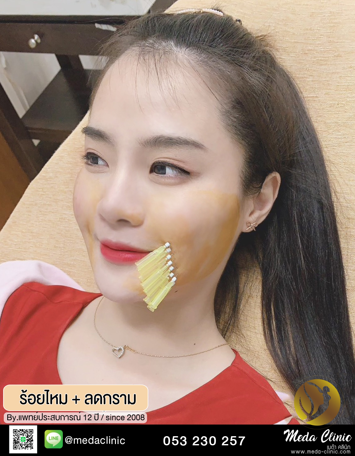 ร้อยไหม + ลดกราม