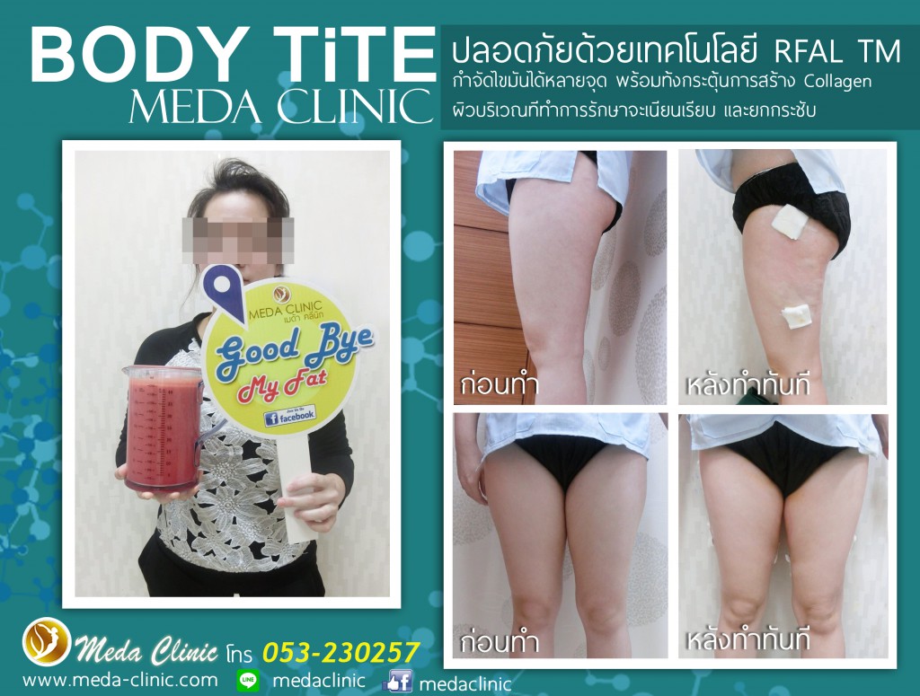 ดูดไขมันBEE copy