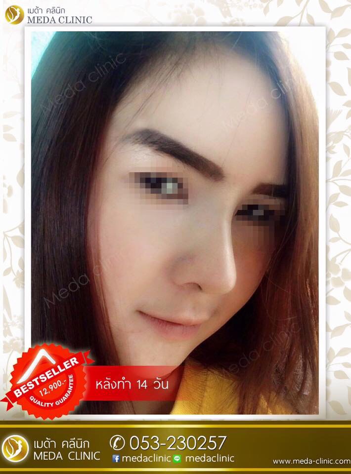 รีวิวเสริมจมูก