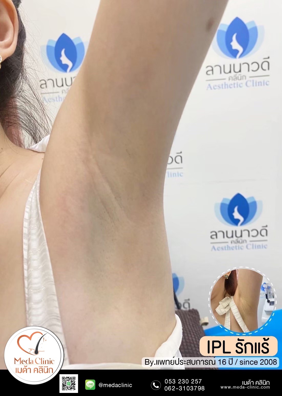 IPL ดีไหม ช่วยอะไรบ้าง?