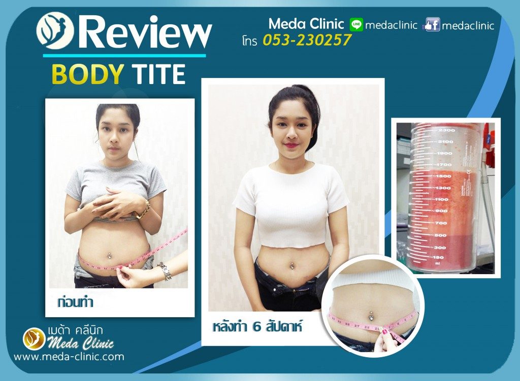 ทำความรู้จักกับวิธีการดูดสลายไขมันส่วนเกิน BodyTite ทางออกของคนอ้วนที่อยากผอมแบบเร่งรัด กับเมด้าคลินิกเชียงใหม่