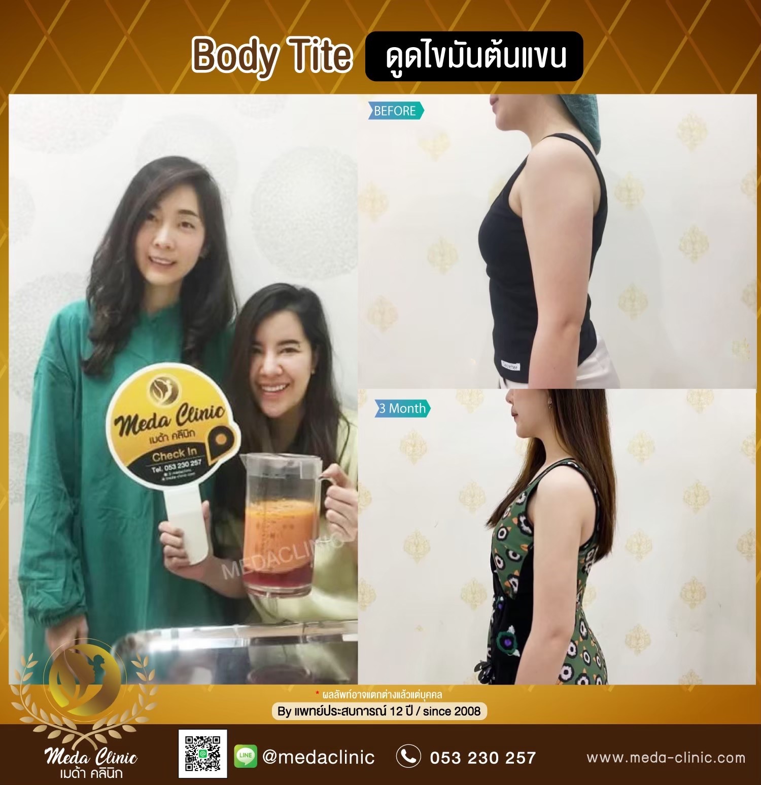 ดูดไขมัน