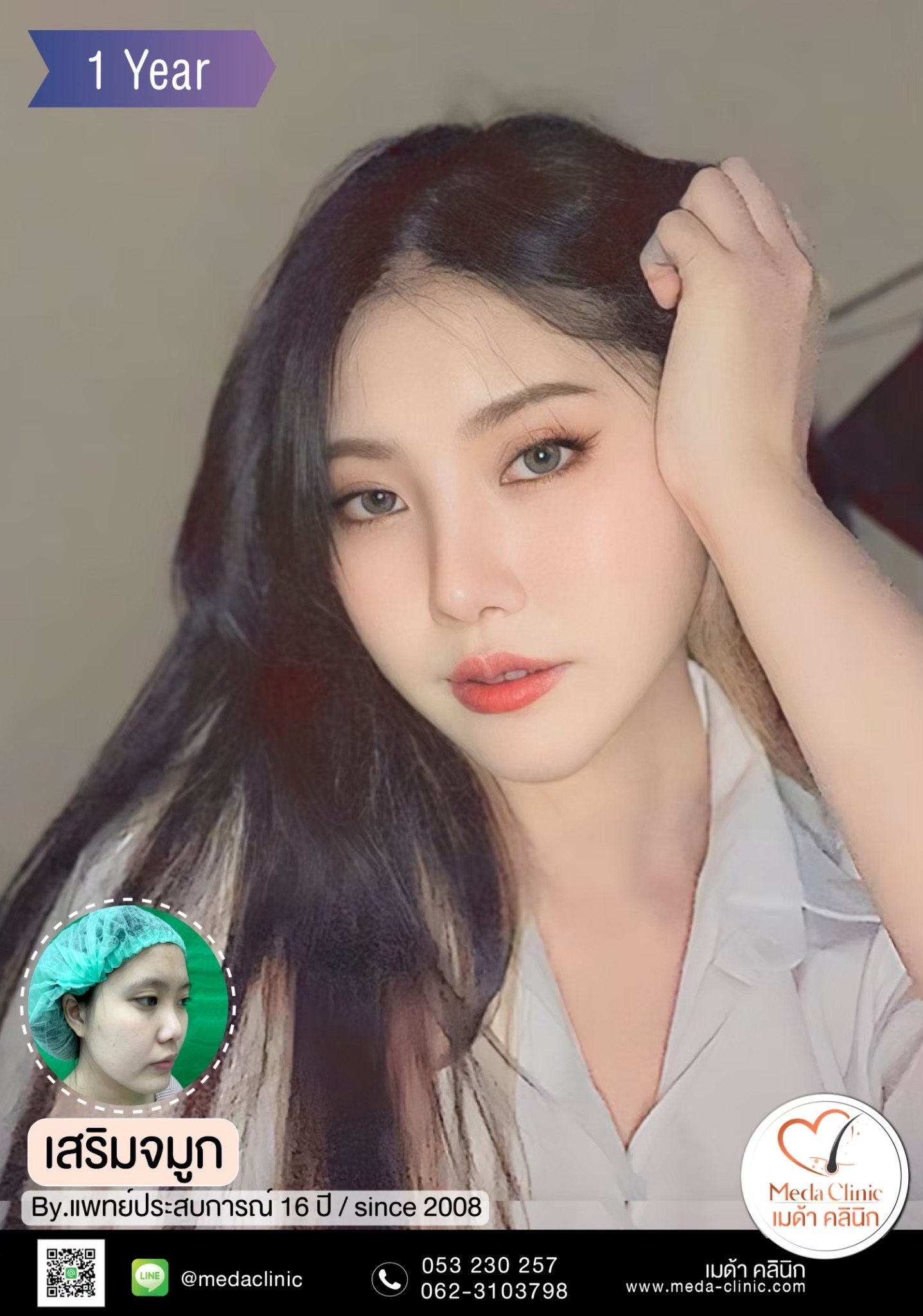 เสริมจมูก