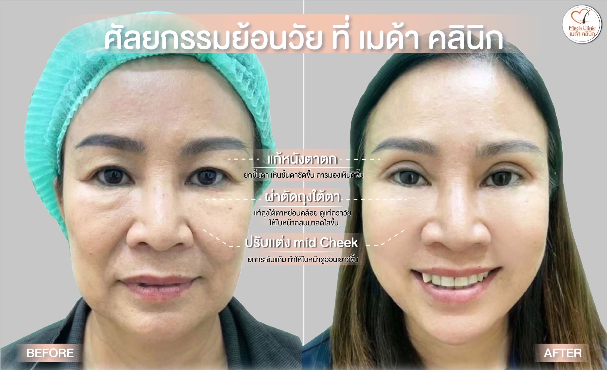ถุงใต้ตา