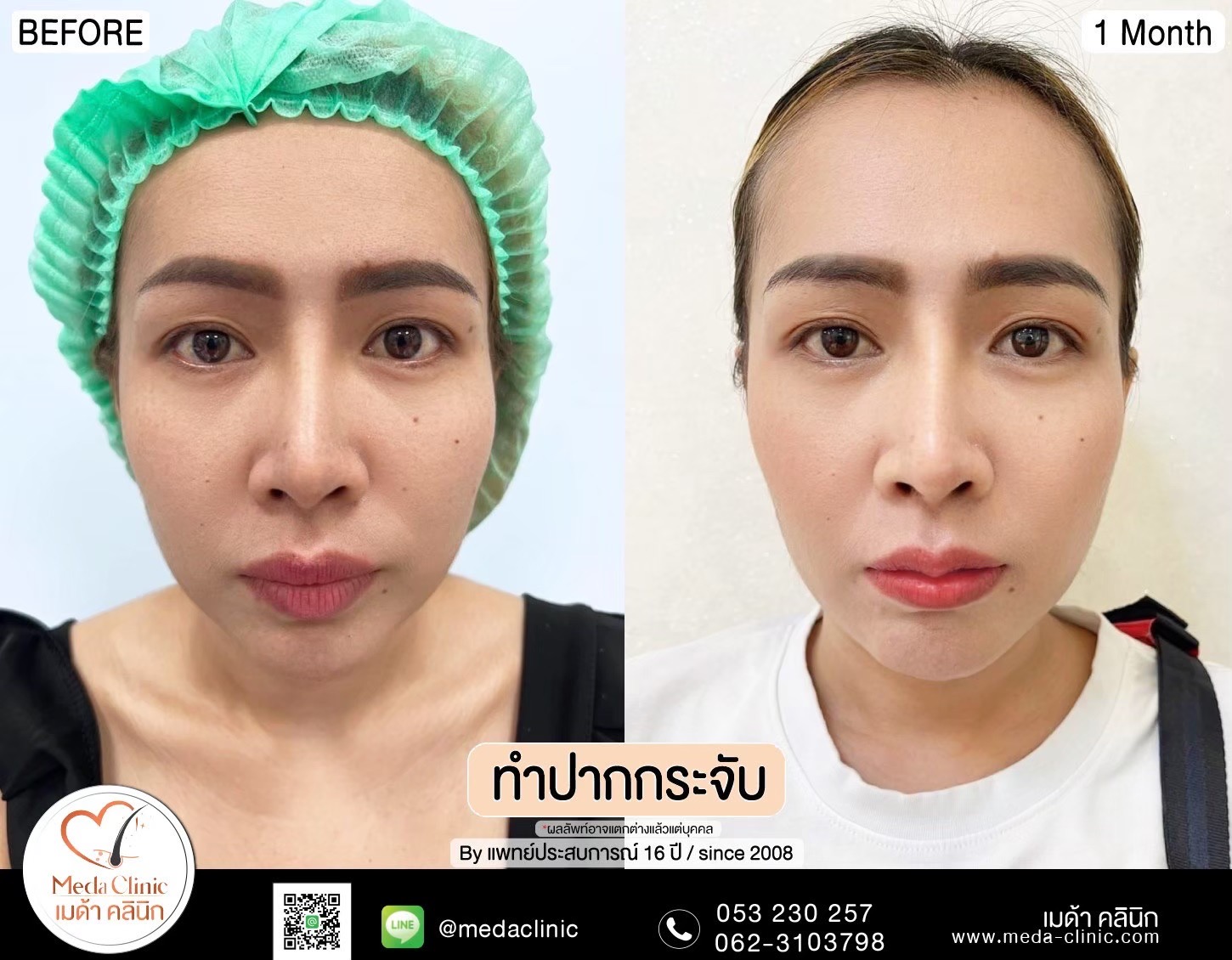 ปากกระจับ