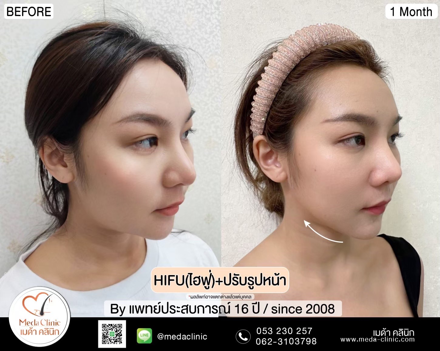 ลดริ้วรอย