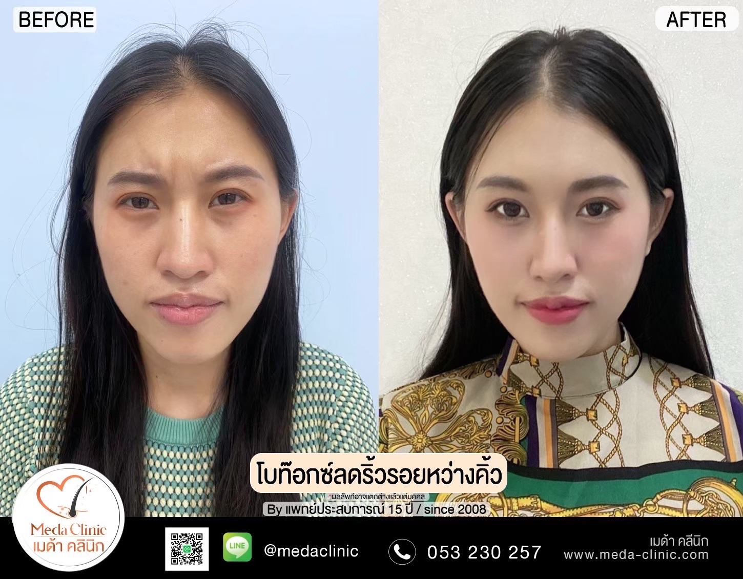ริ้วรอยบนใบหน้าคืออะไร