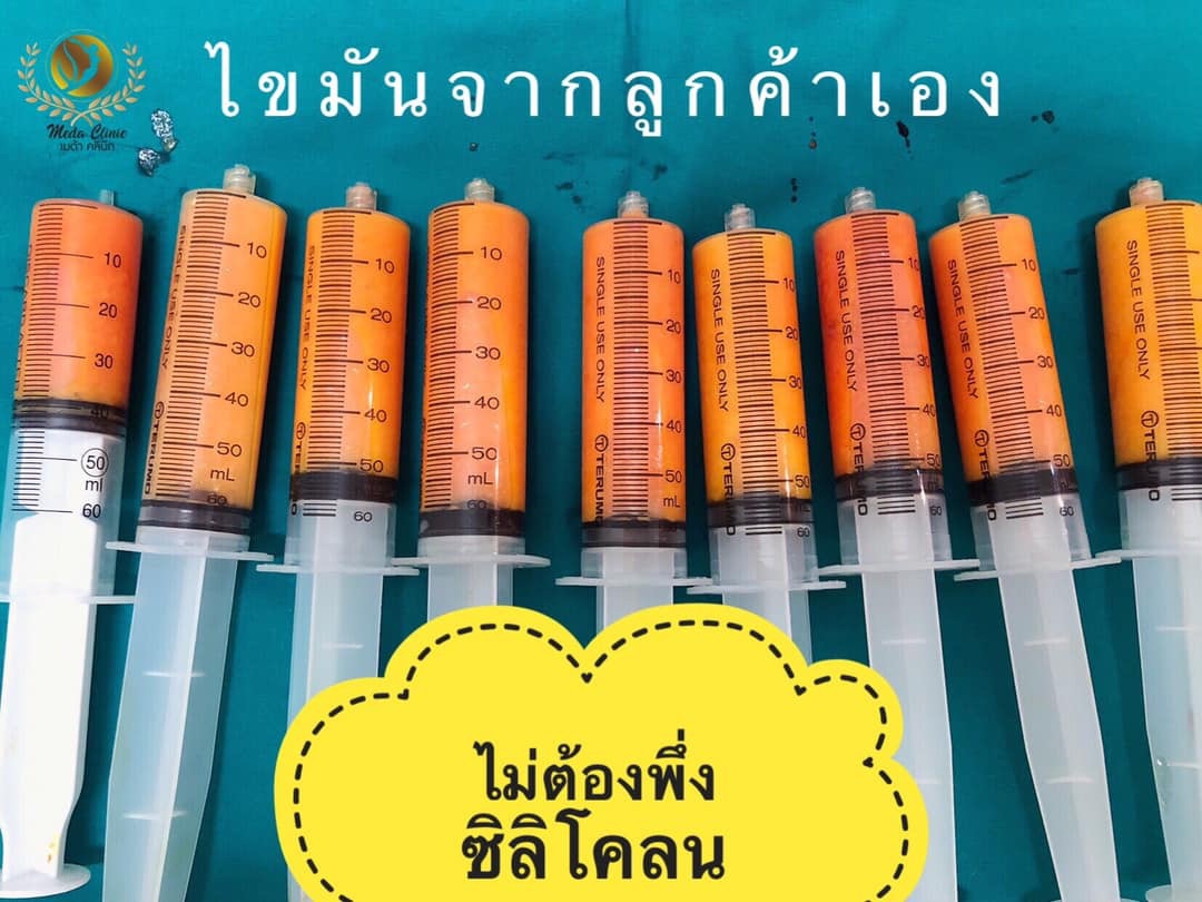 ฉีดไขมันหน้าอกFAT CELL