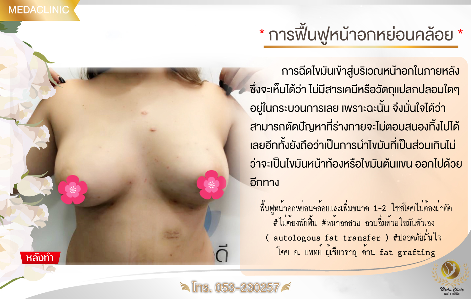 ฉีดไขมันหน้าอกFAT CELL