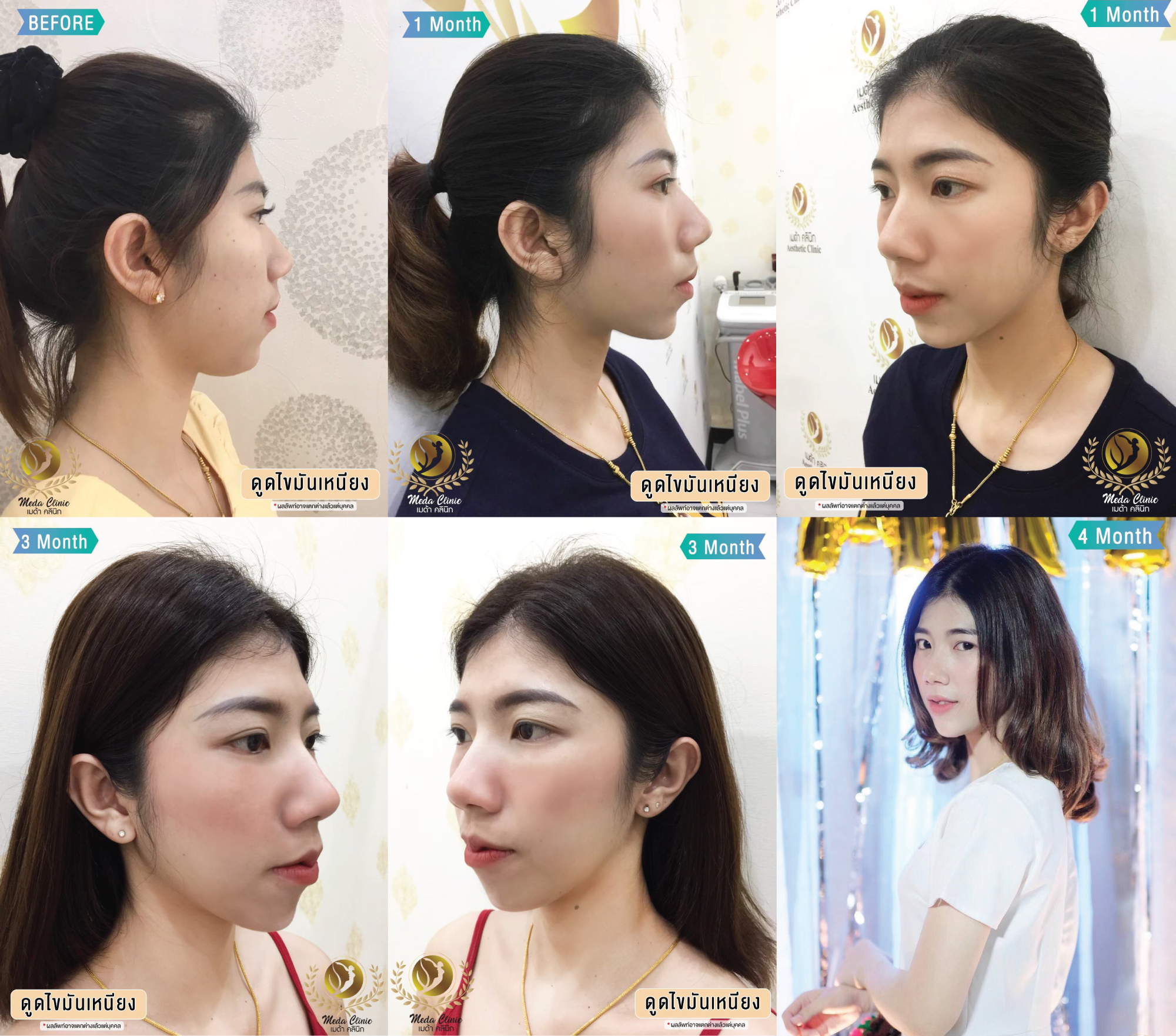 ดูดไขมันเหนียง ดูดไขมันเหนียง