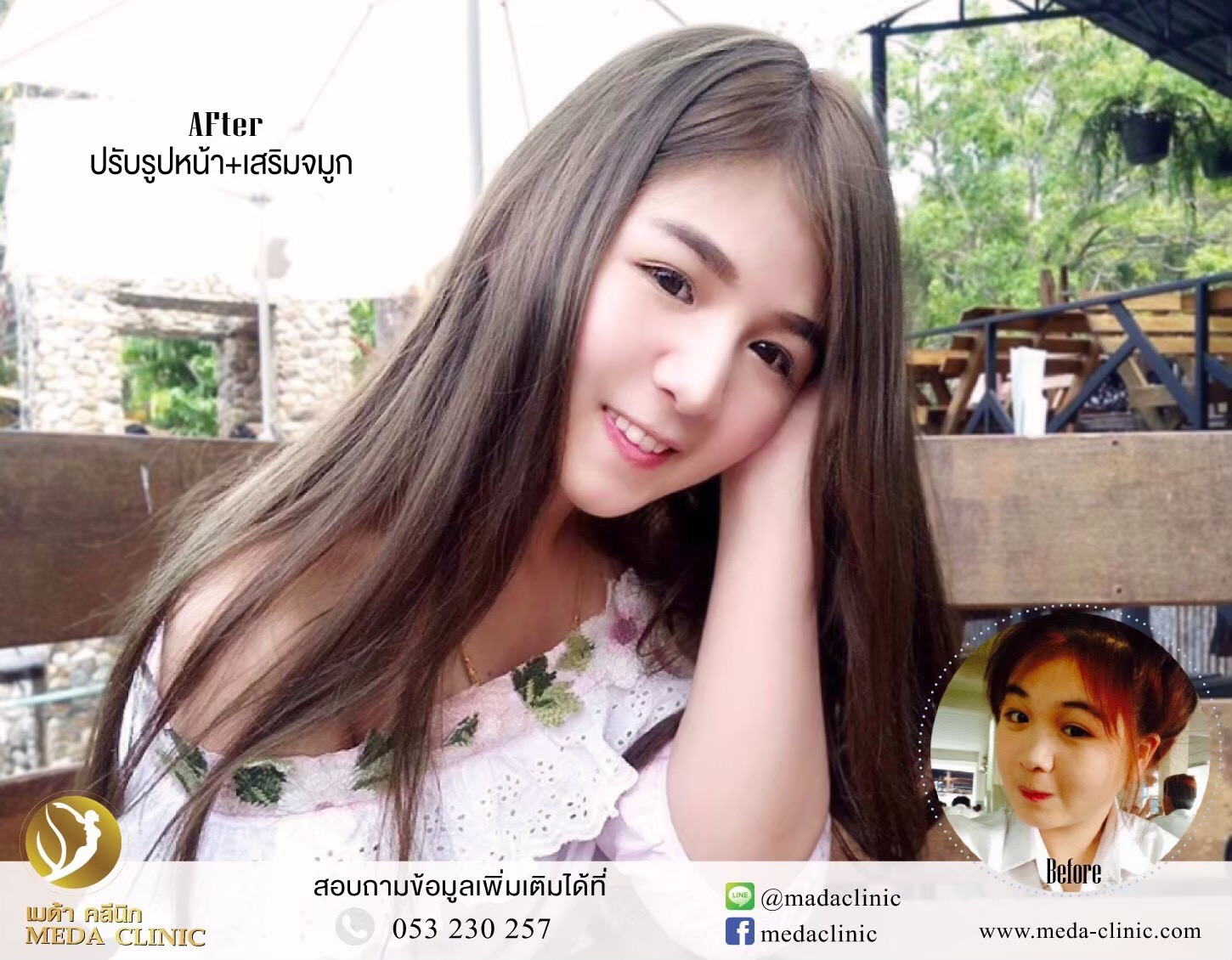 ปรับรูปหน้า+เสริมจมูก