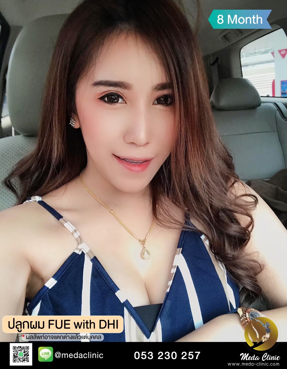 ปลูกผม
