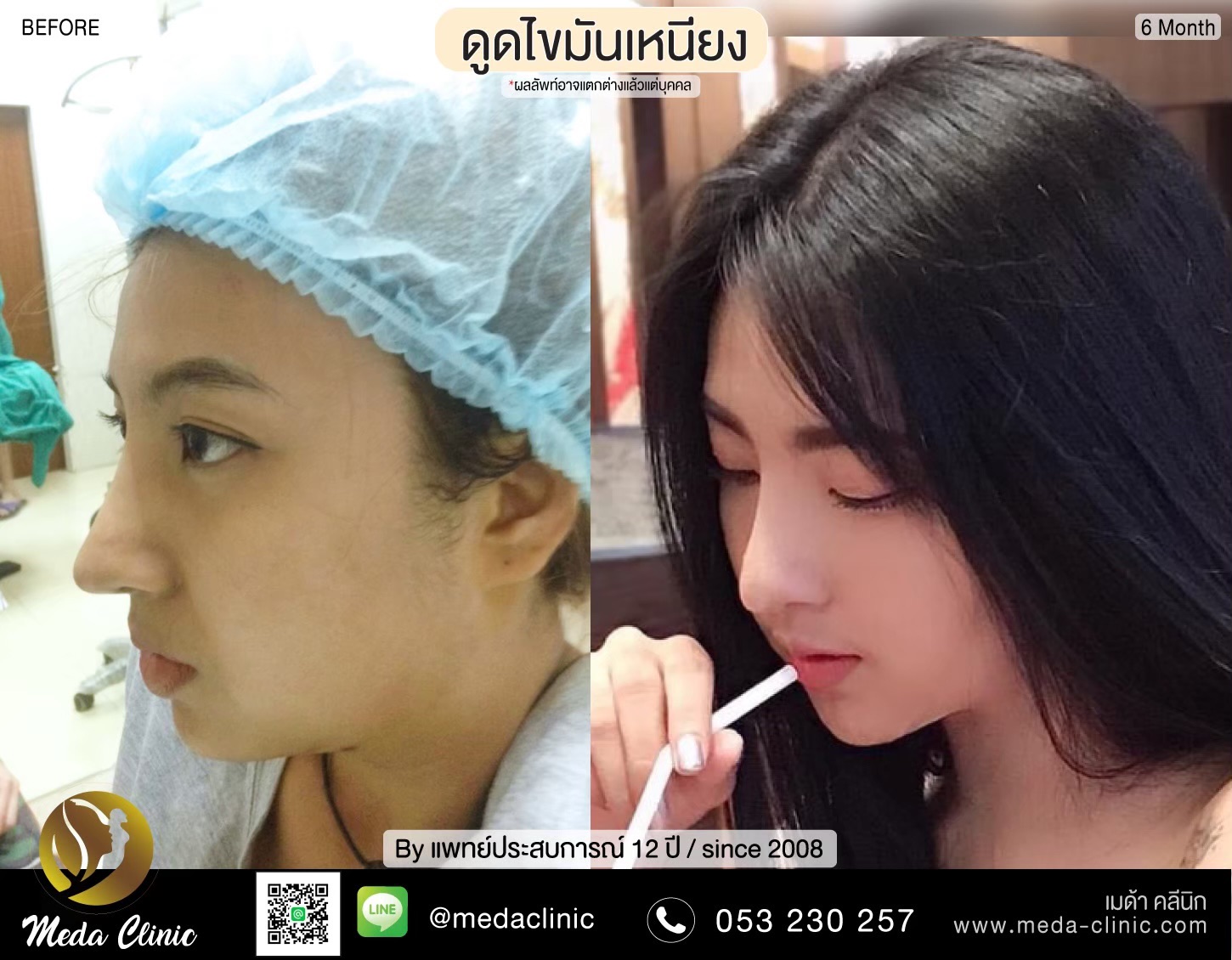 ดูดไขมันเหนียง ดูดไขมันเหนียง