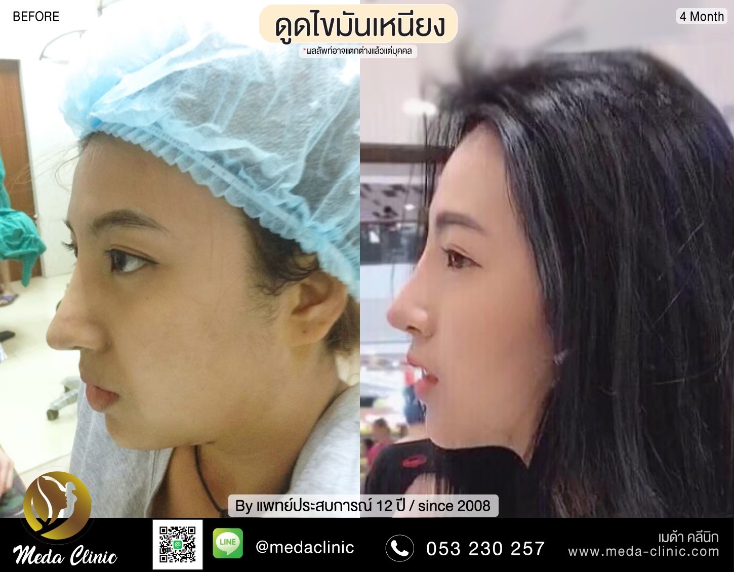 ดูดไขมันเหนียง ดูดไขมันเหนียง