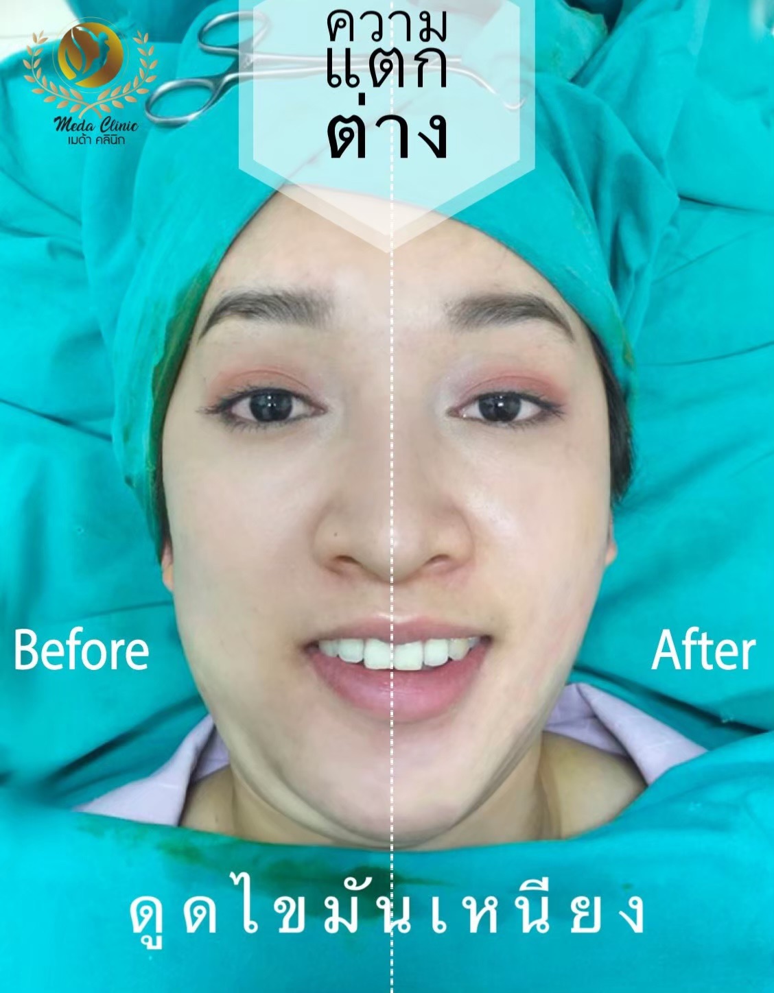 ดูดไขมันเหนียง ดูดไขมันเหนียง