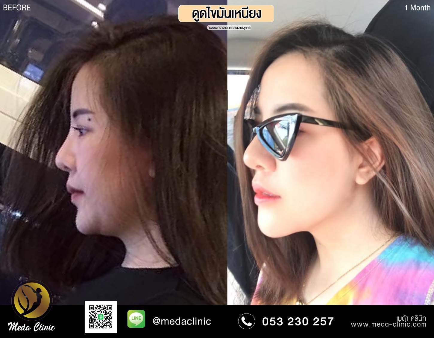 ดูดไขมันเหนียง ดูดไขมันเหนียง