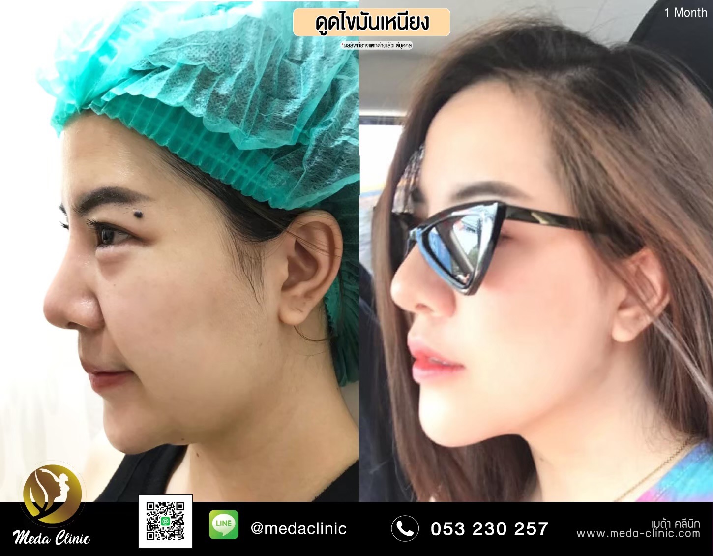 ดูดไขมันเหนียง ดูดไขมันเหนียง
