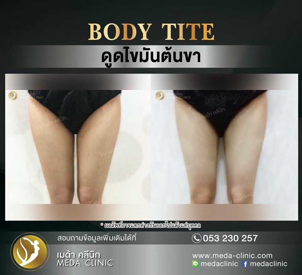 รีวืวดูดไขมัน เชียงใหม่