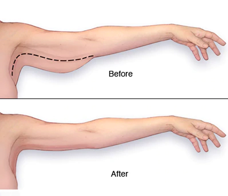 Arm liposuction