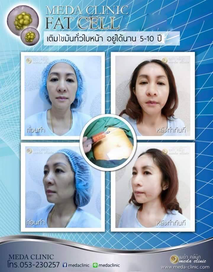 ฉีดไขมันหน้าเชียงใหม่2023