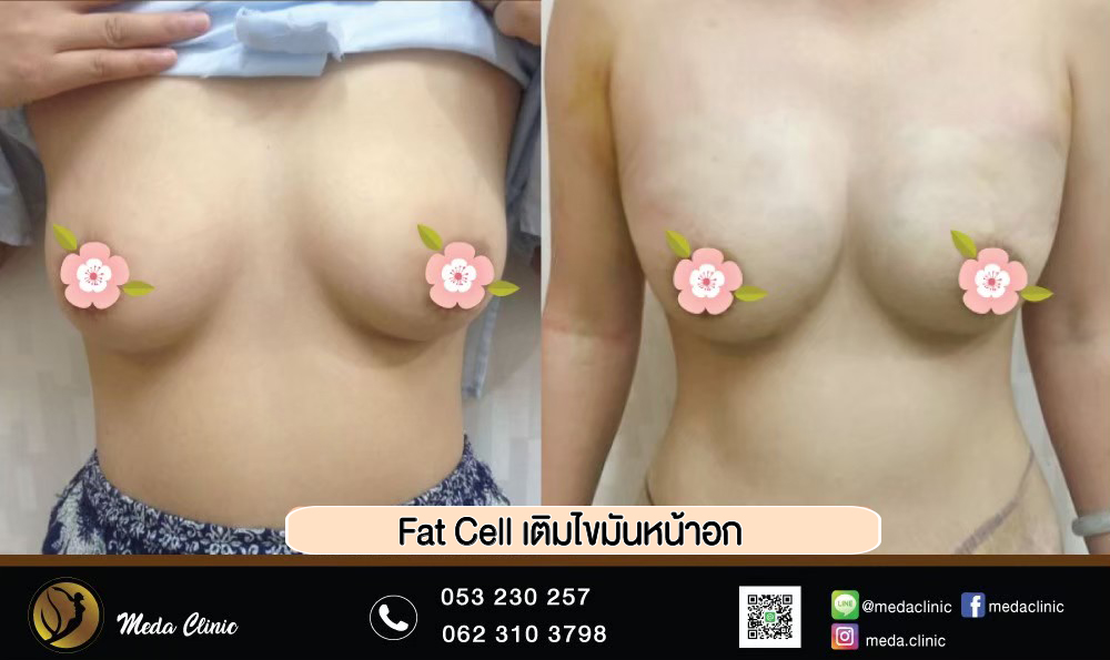 ฉีดไขมันหน้าอกFAT CELL