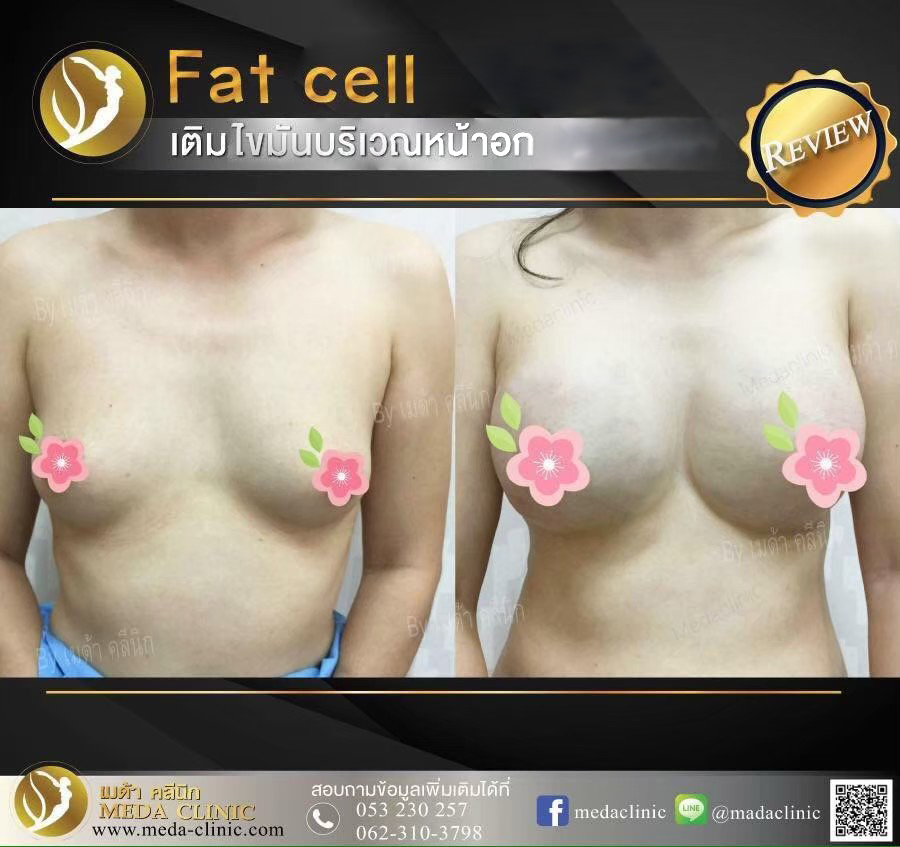 ฉีดไขมันหน้าอกFAT CELL