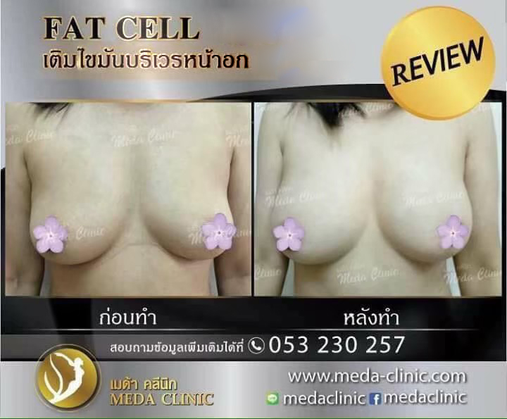 ฉีดไขมันหน้าอกFAT CELL