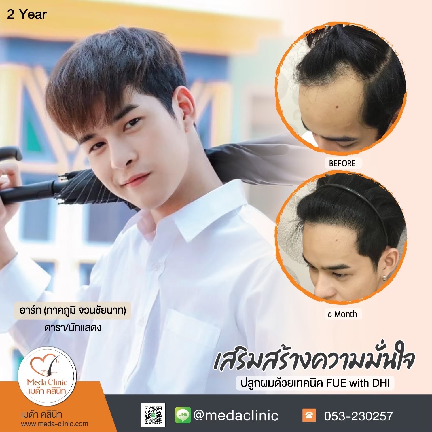 รีวิวปลูกผม