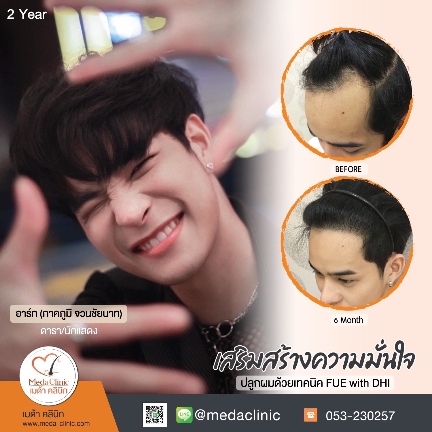 รีวิวปลูกผม