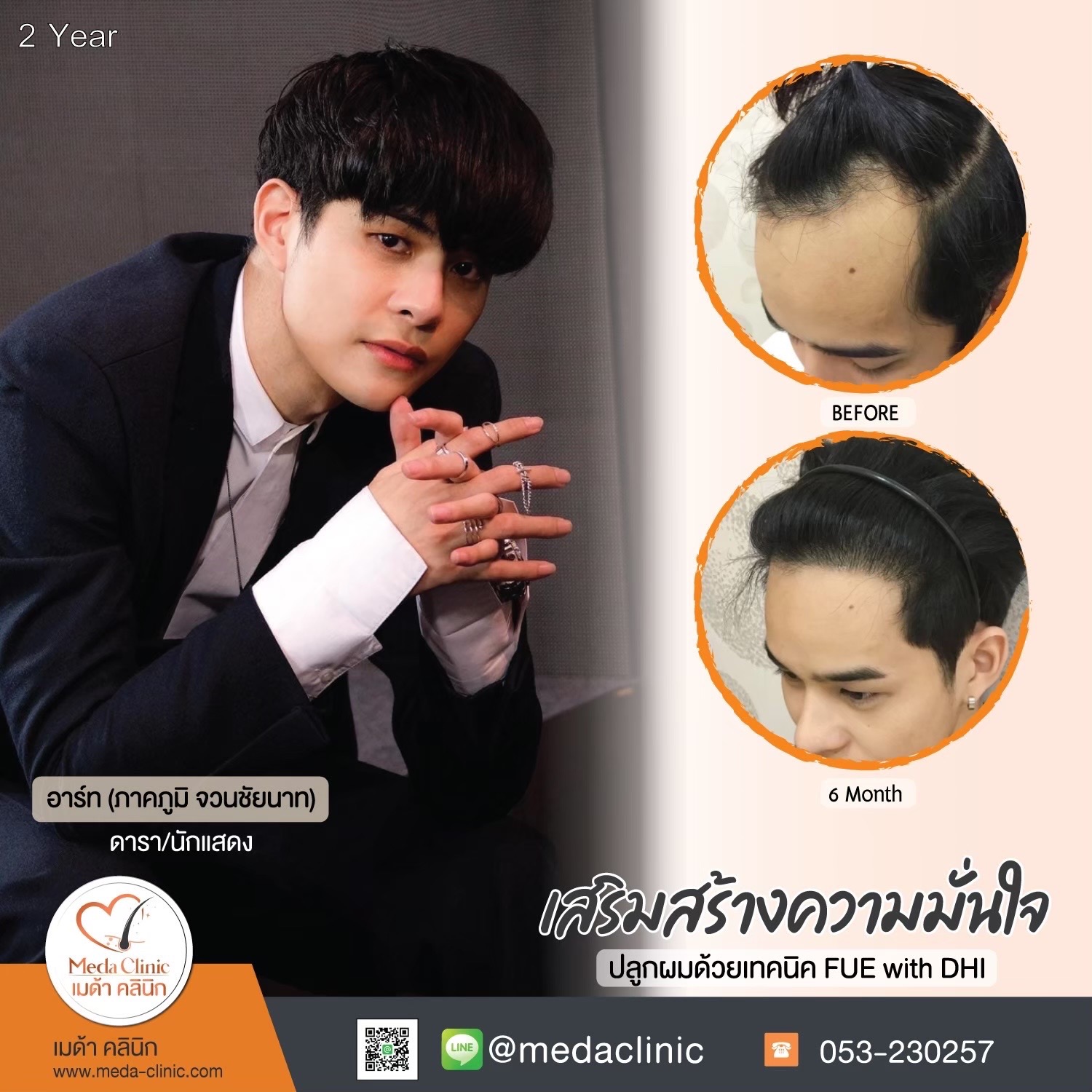 รีวิวปลูกผม