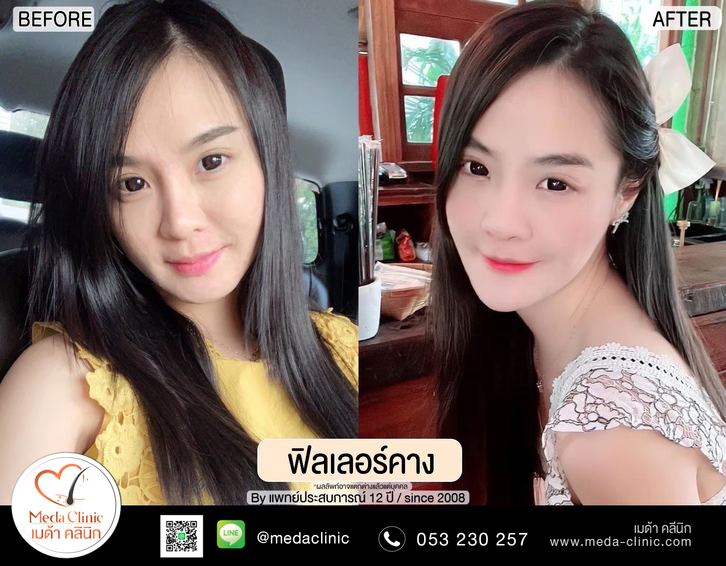 รีวิวฉีดฟิลเลอร์