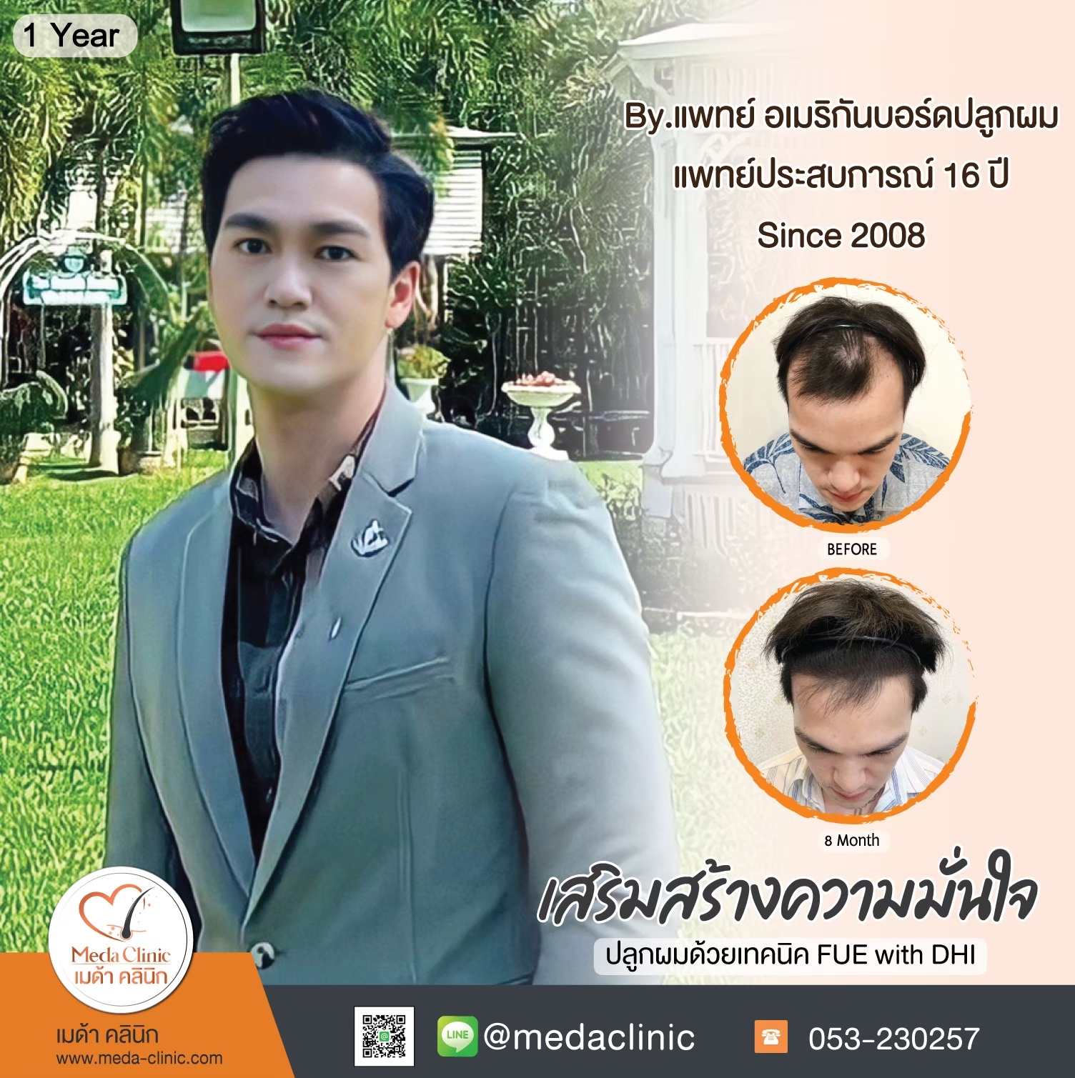 ปลูกผม