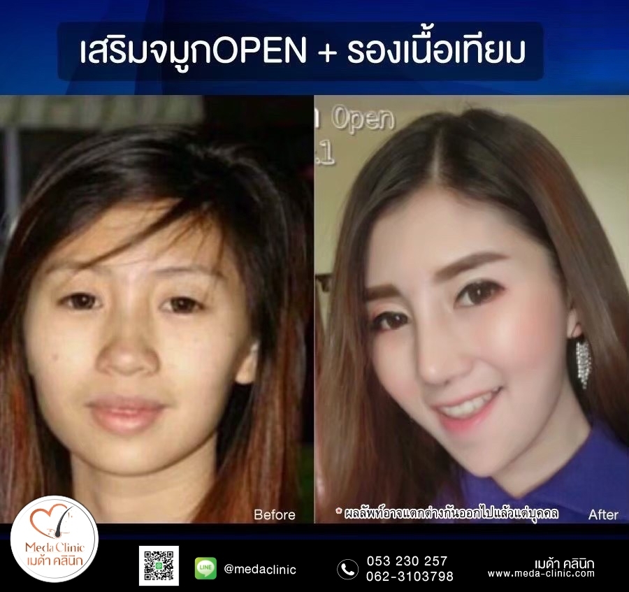 เสริมจมูฏ เมด้า