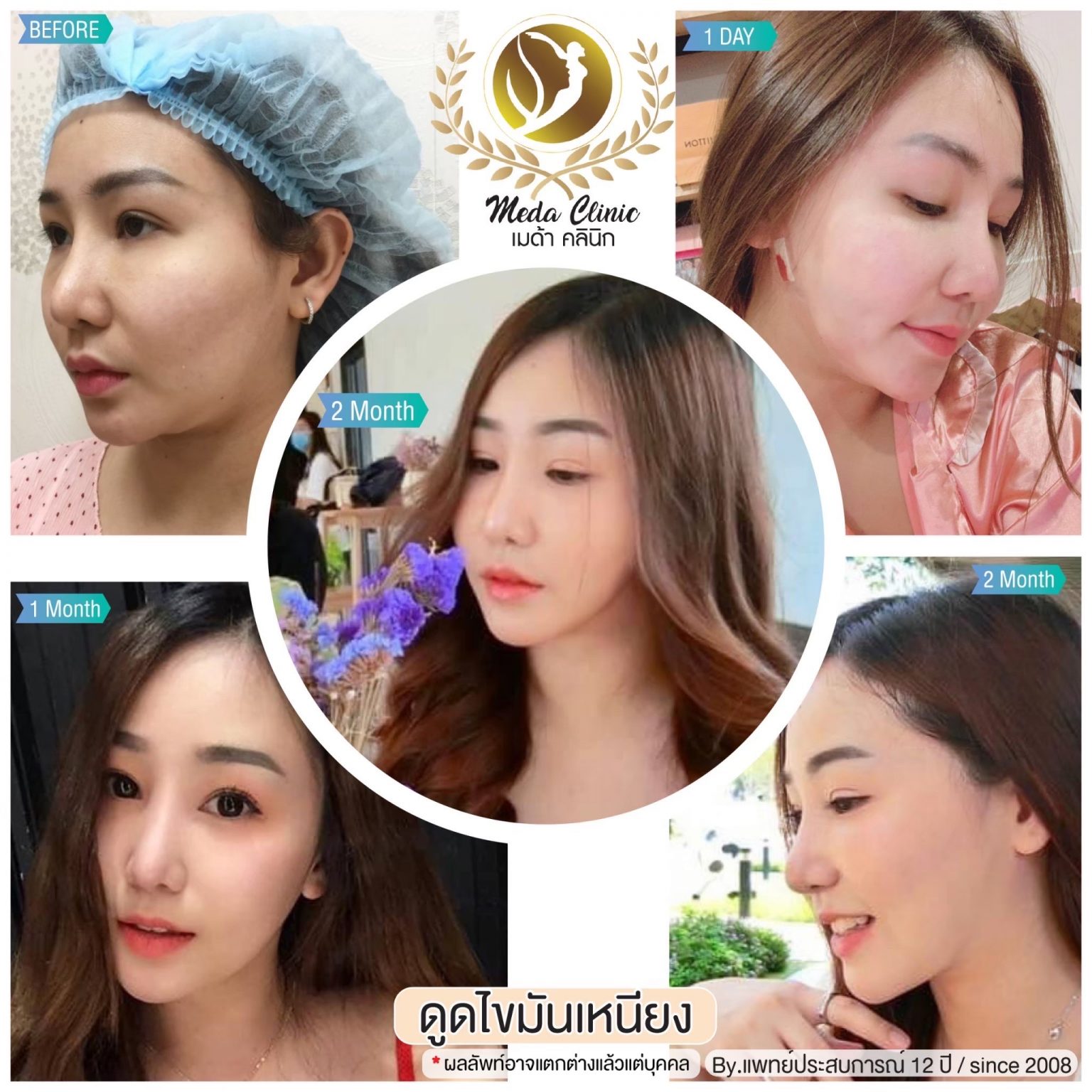ดูดไขมัน