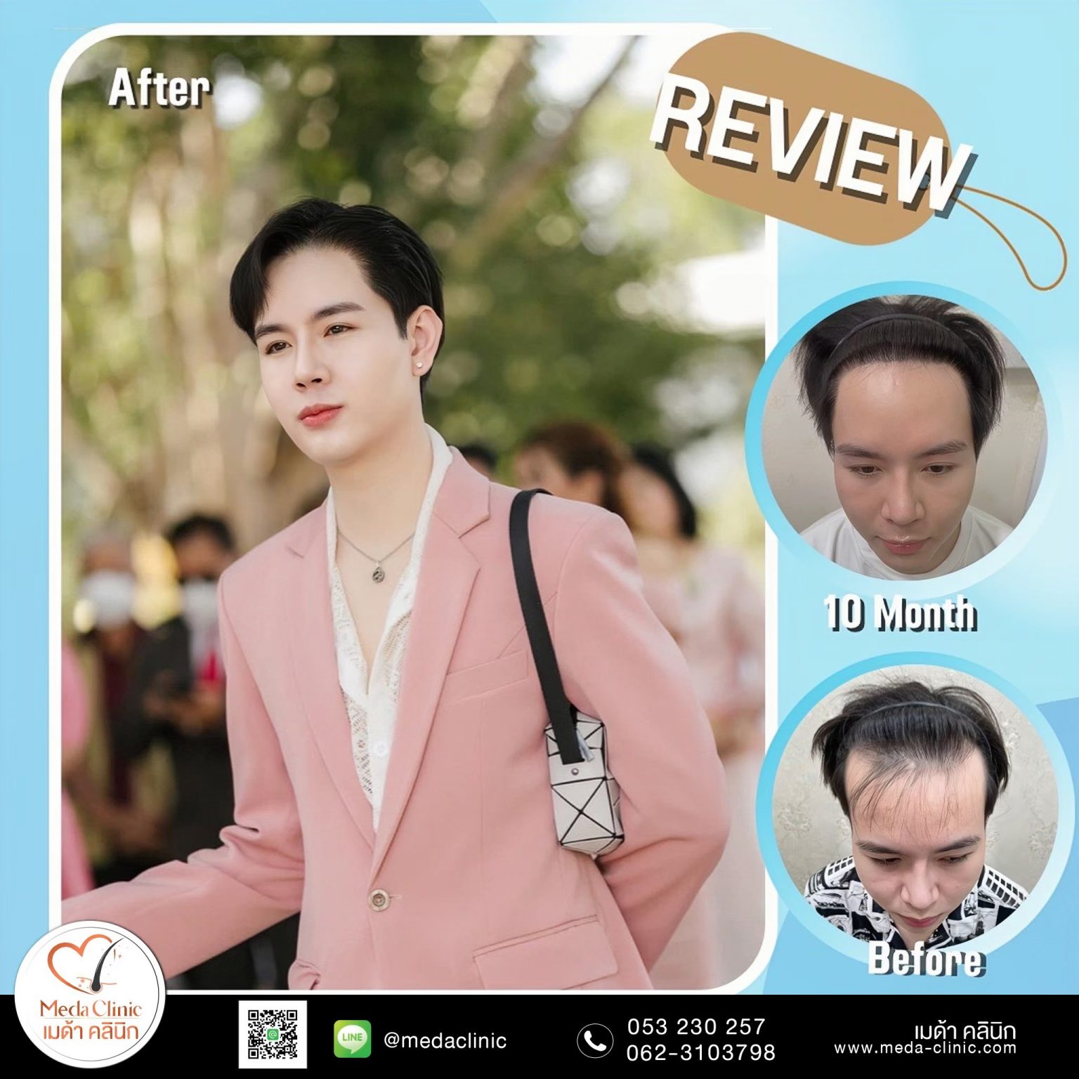 hair transplant 1