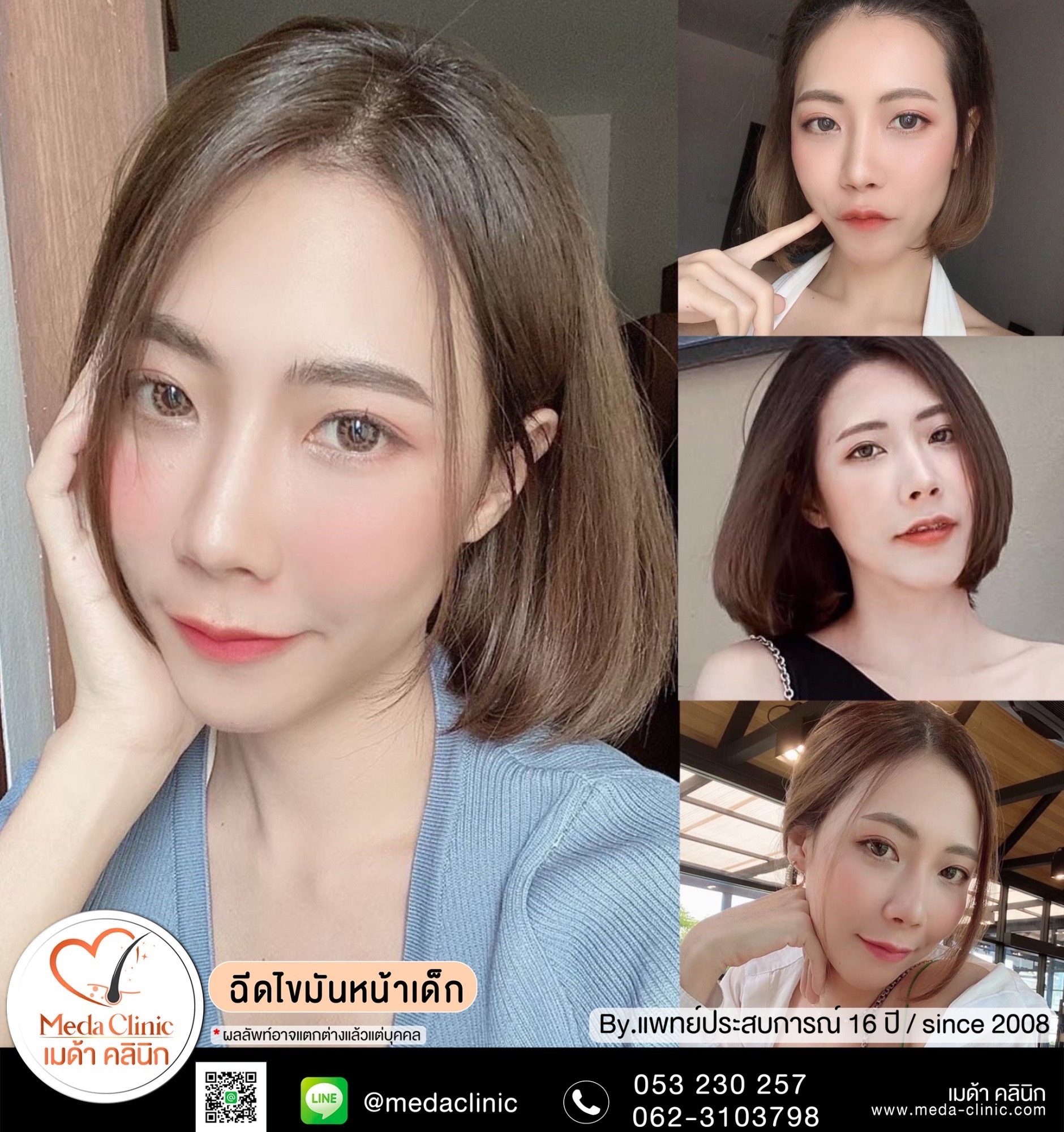 ฉีดไขมันหน้า