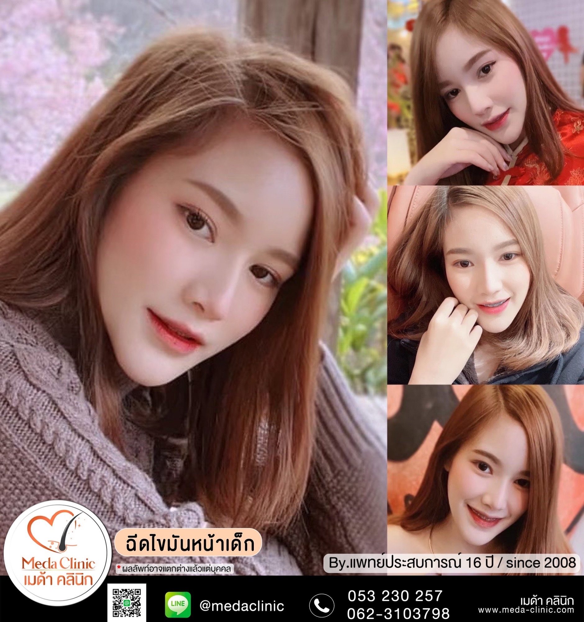 ฉีดไขมันหน้า