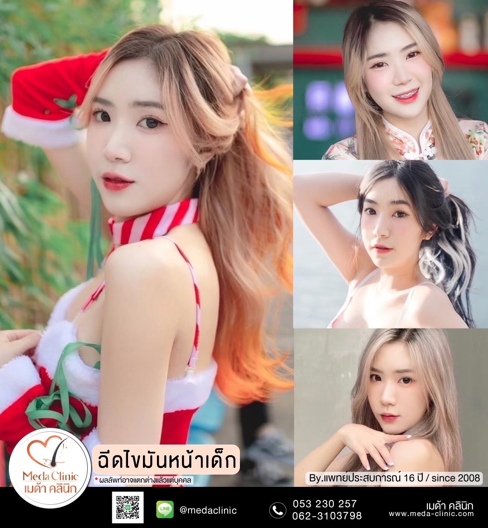 ฉีดไขมันหน้า