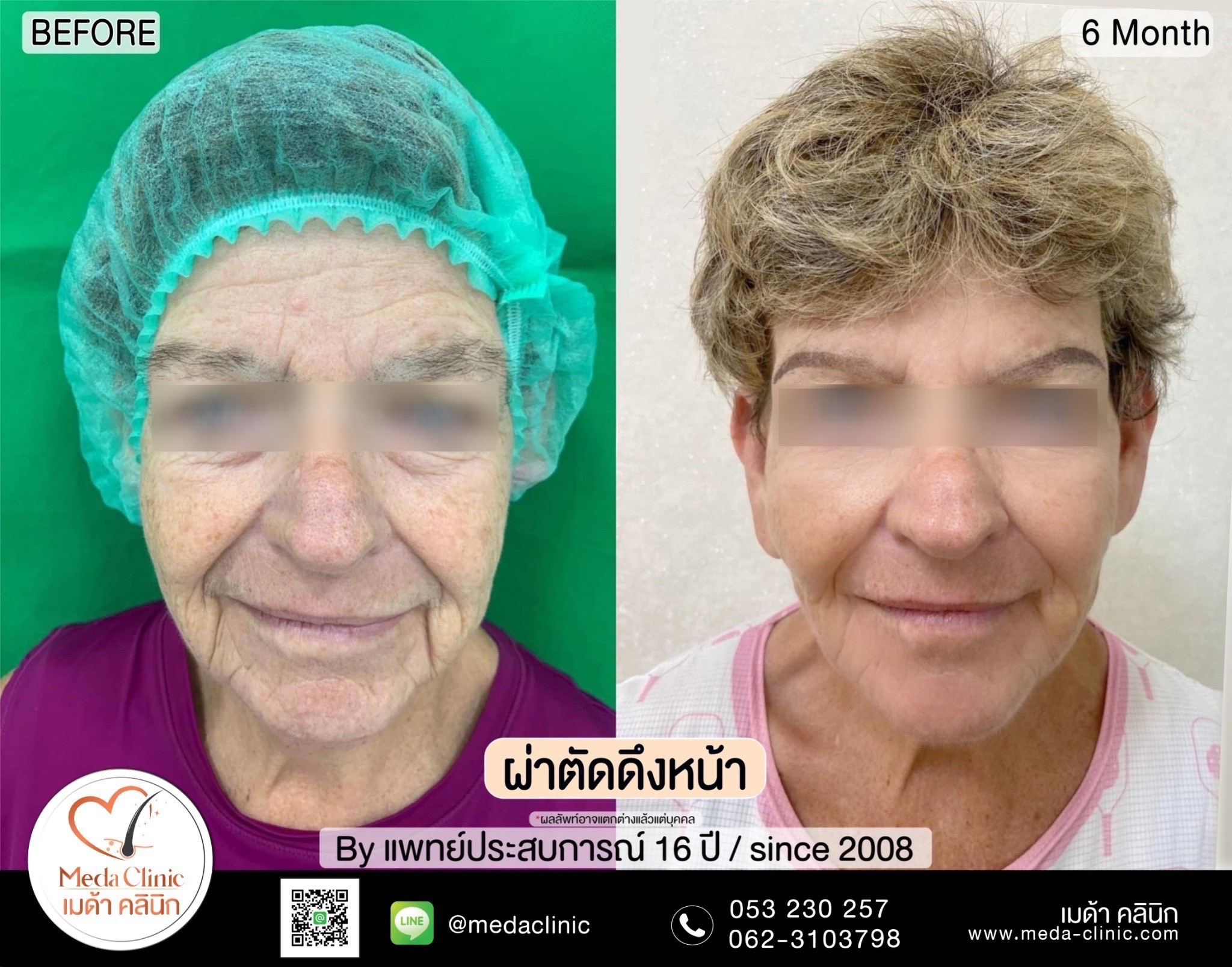 Facelift Surgery Chiang mai,