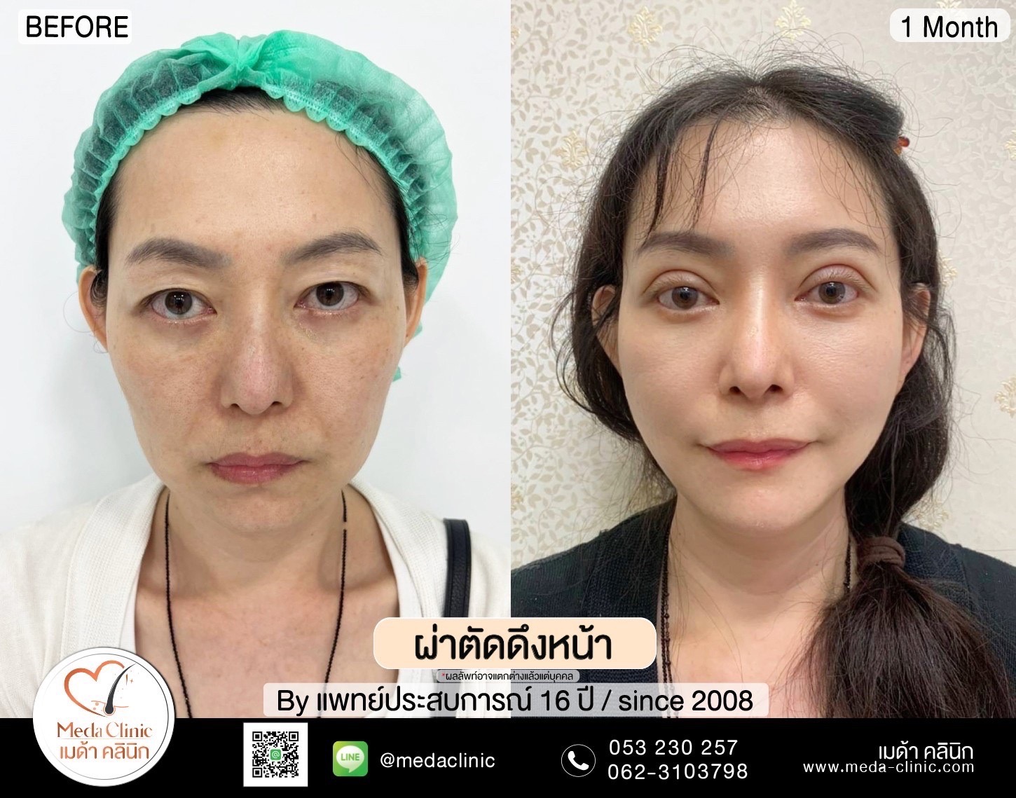 Facelift Surgery Chiang mai,