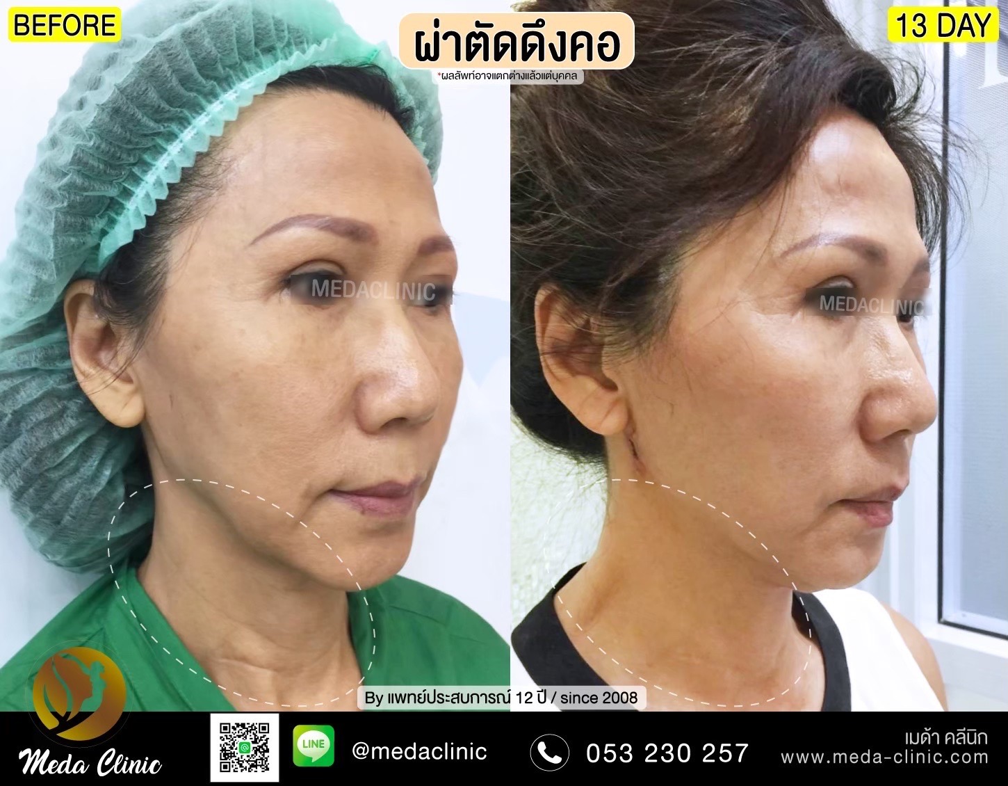 Facelift Surgery Chiang mai,