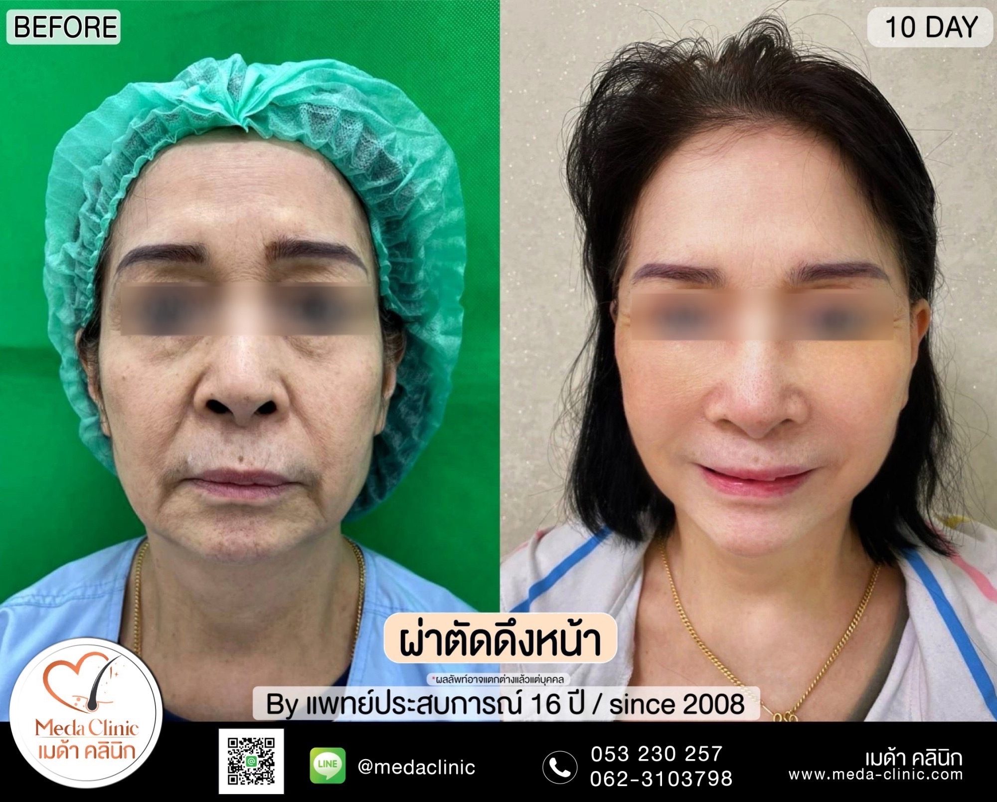 ผ่าตัดดึงหน้า