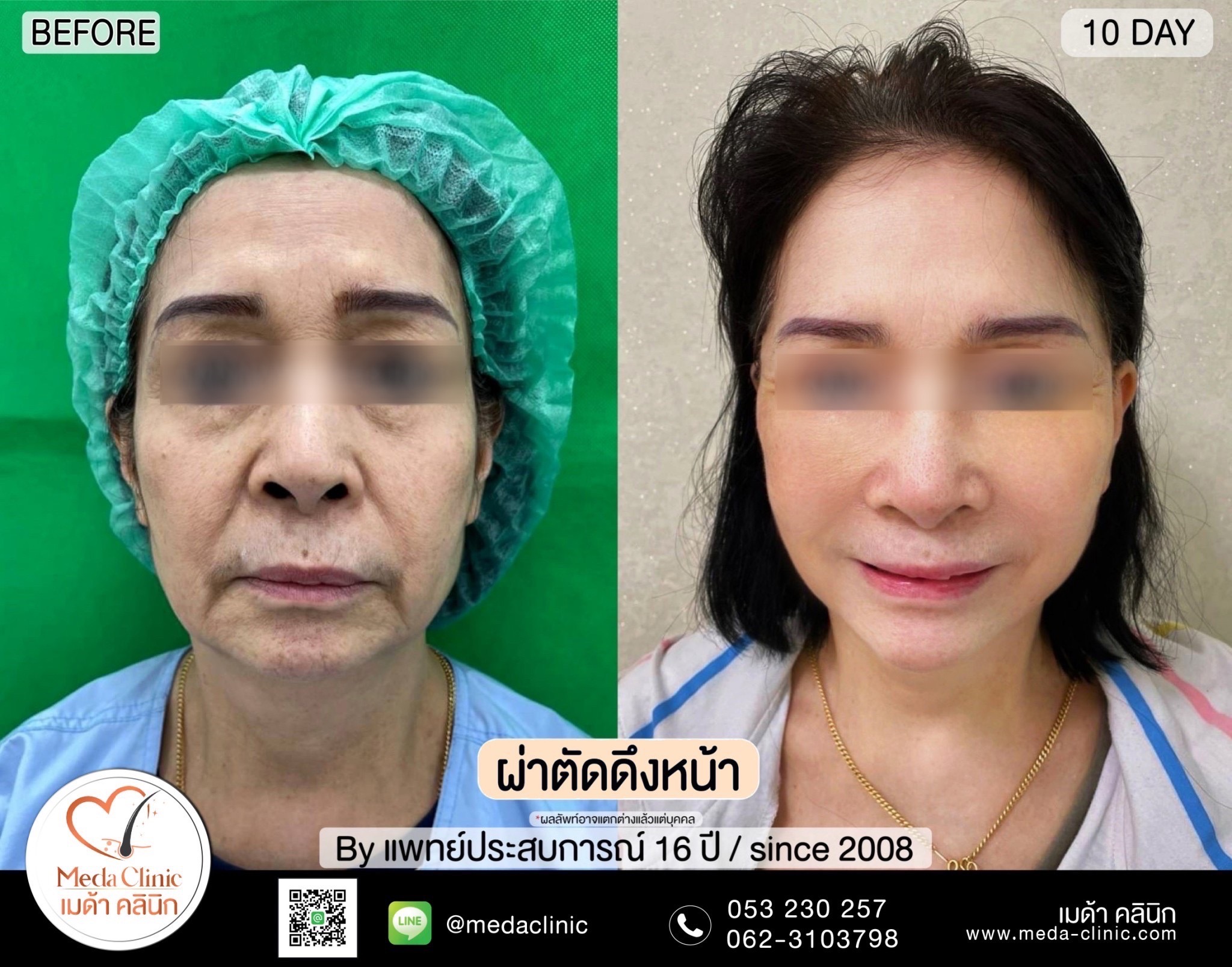 Facelift Surgery Chiang mai,