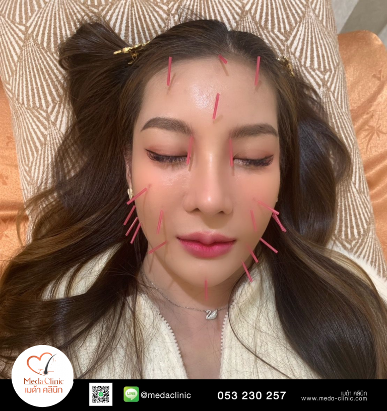 ฝังเข็มเชียงใหม่