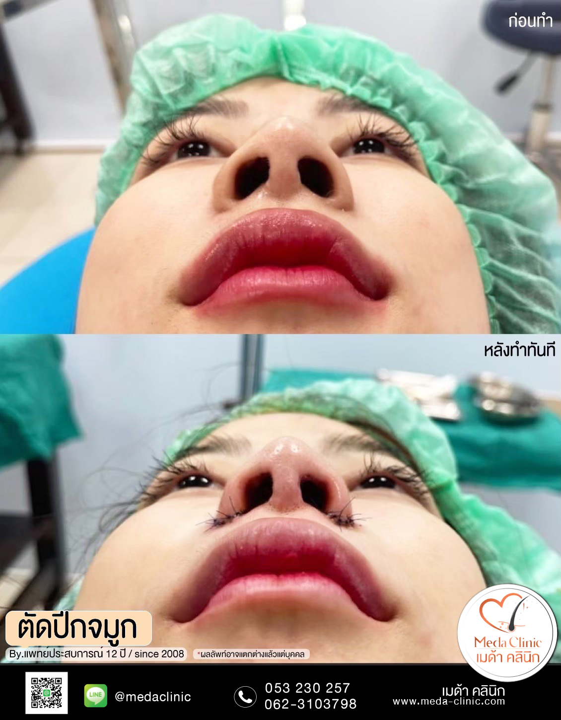 ตัดปีดจมูก