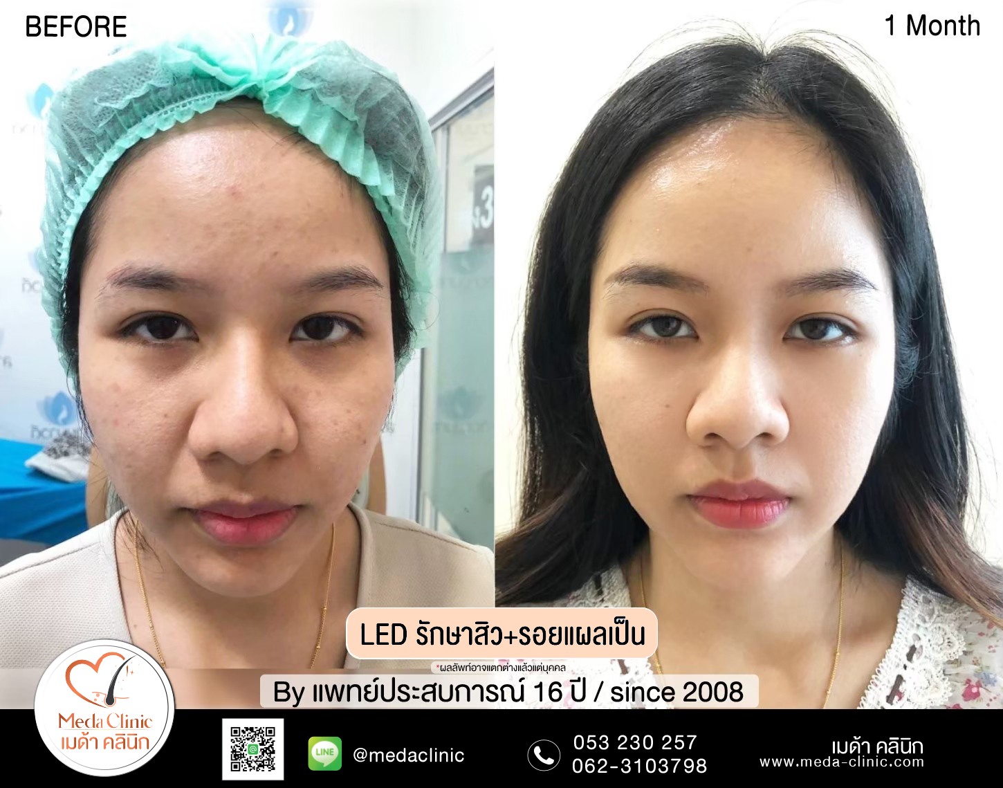 รักษาหลุมสิว รอยแผลเป็นเชียงใหม่