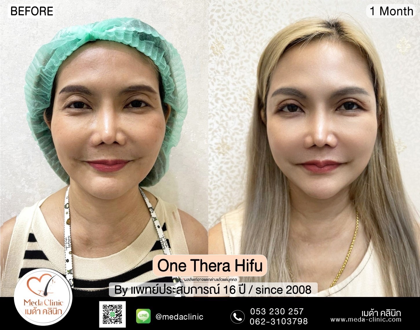 รีวิว onetherahifu