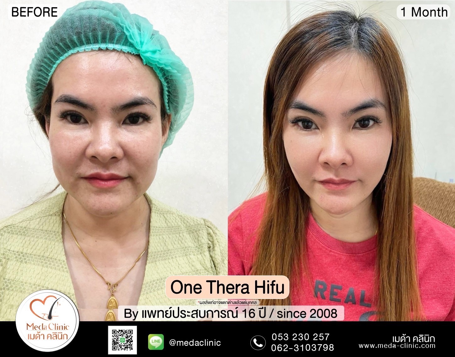 รีวิว onetherahifu